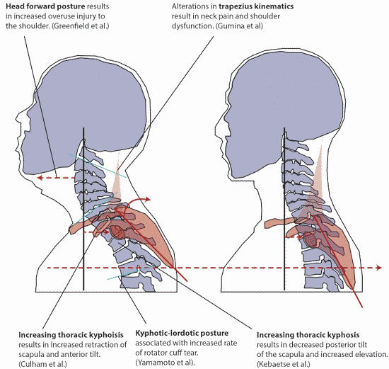 Illustration comparing forward-head and thoracic positions and their relationship to the neck, shoulder blade, and upper trapezius
