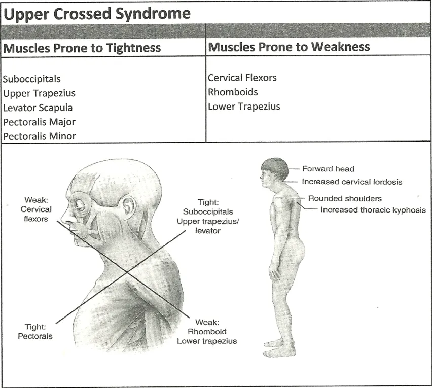 Upper Crossed Syndrome teaching model showing muscles described as prone to tightness and weakness